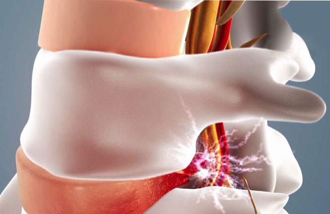 根據(jù)具體原因選擇腰突較好的治療方法 根據(jù)具體原因選擇腰突較好的治療方法