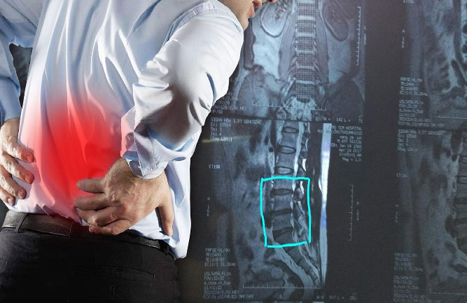 腰間盤(pán)突出怎么鍛煉好的快