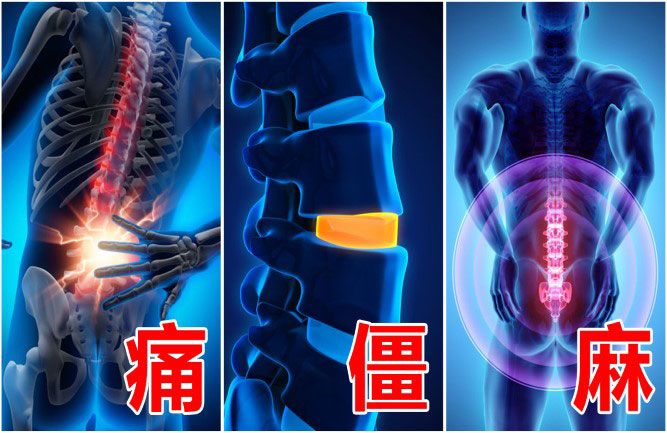 治療腰椎間盤突出最好的方法主要有幾種 治療腰椎間盤突出最好的方法主要有幾種